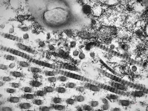 F, 45y. | necrobiosis lipoidica